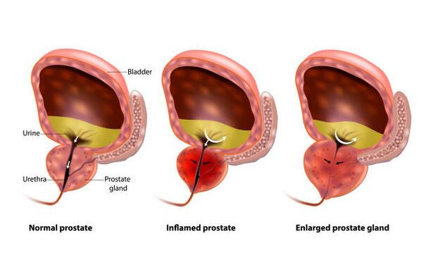 prostatitis is een ontsteking van de prostaatklier