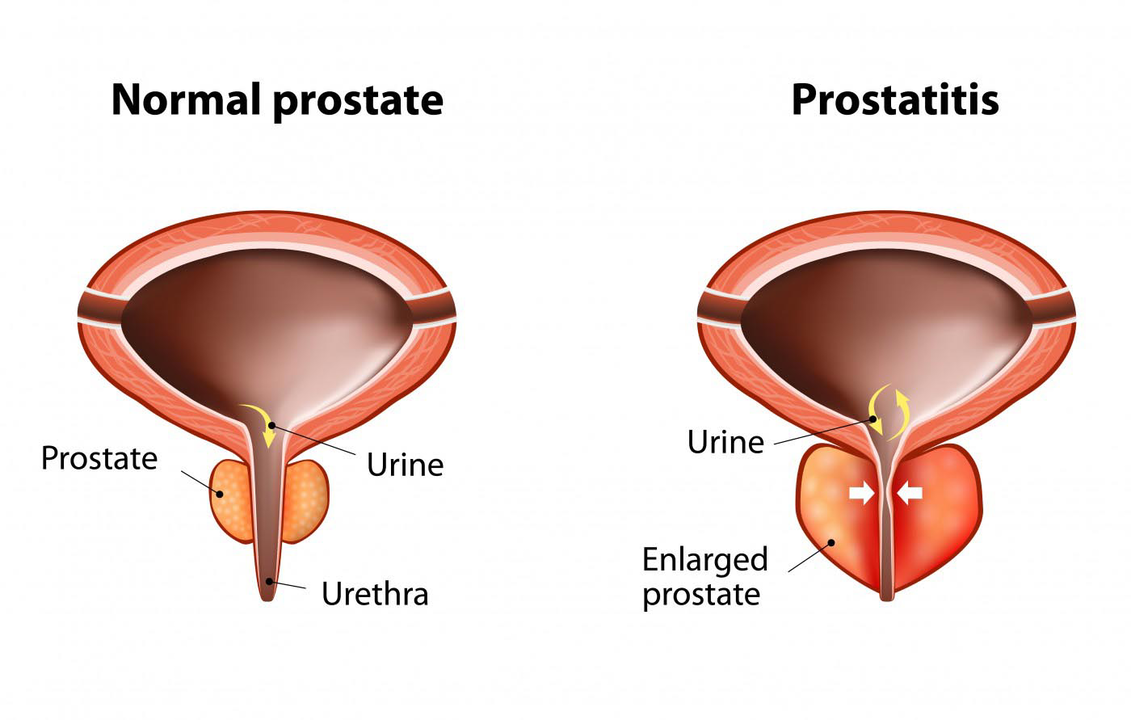 Normale prostaat van een gezonde man en ontsteking van de prostaatklier met prostatitis
